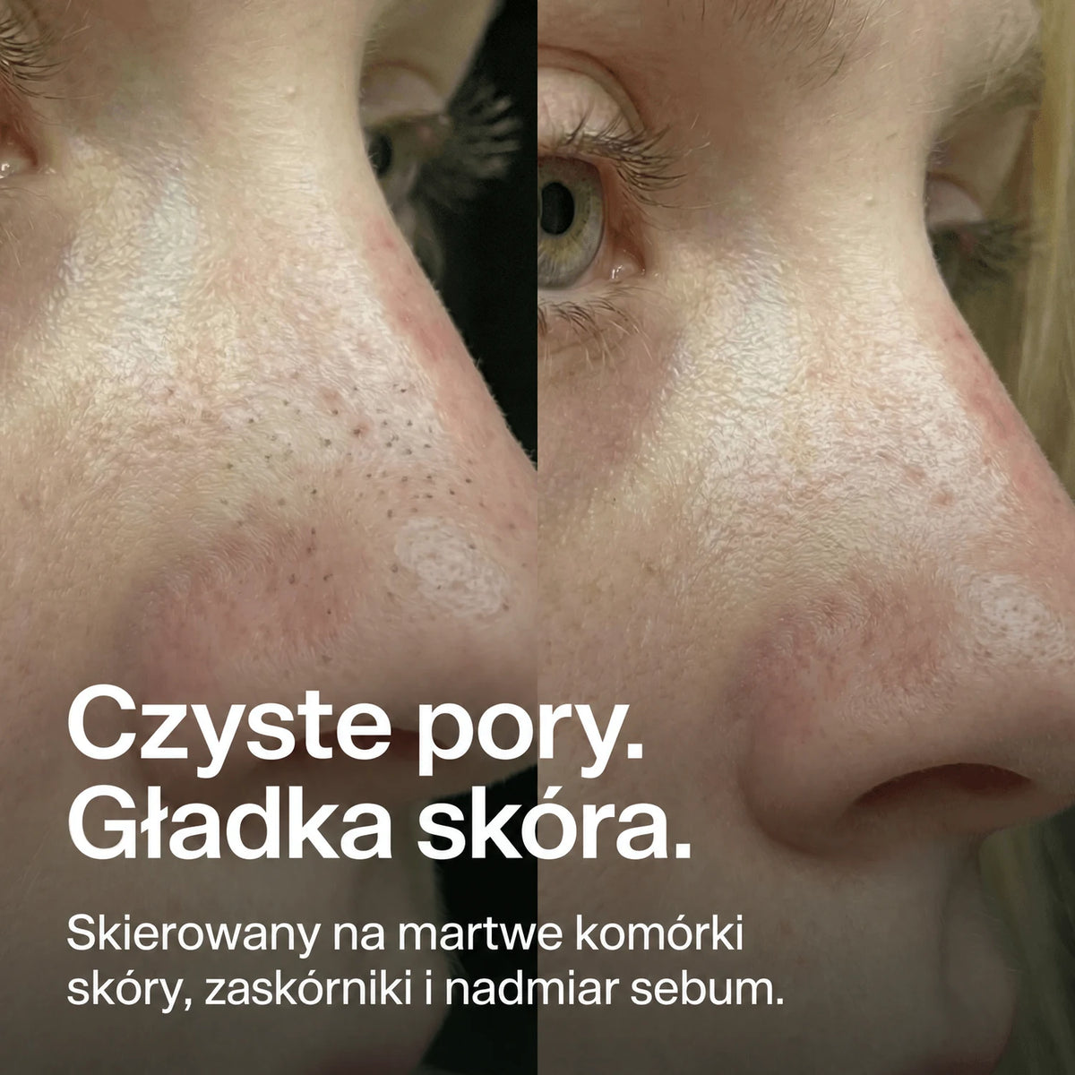nose-patches gallery 5 (pl)