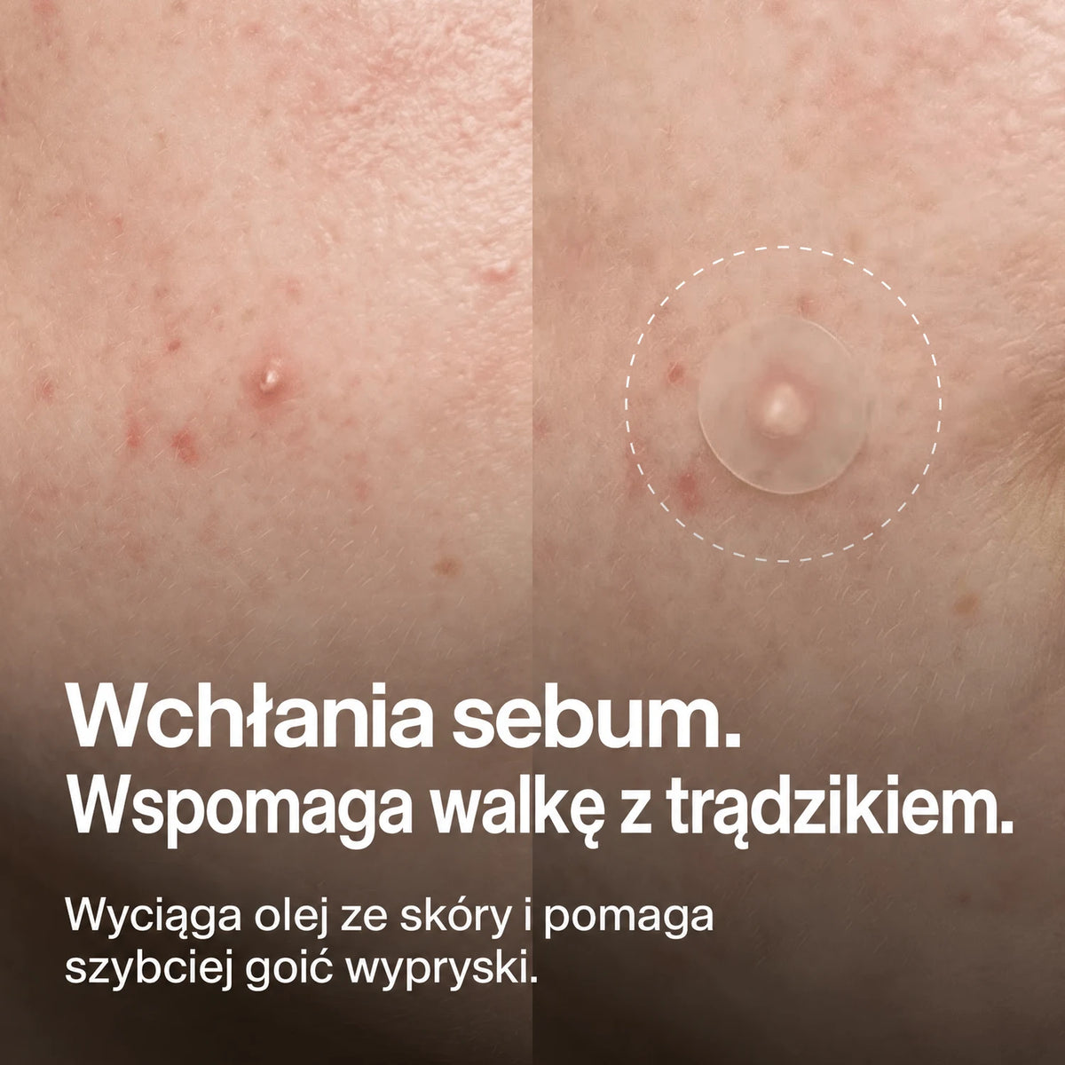 clear-dots-acne-patches gallery 2 (pl)