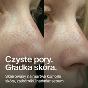 nose-patches gallery 5 (pl)