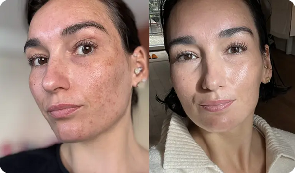 Mijn huid is rustiger én egaler