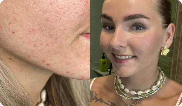 De rode vlekken verdwijnen sneller