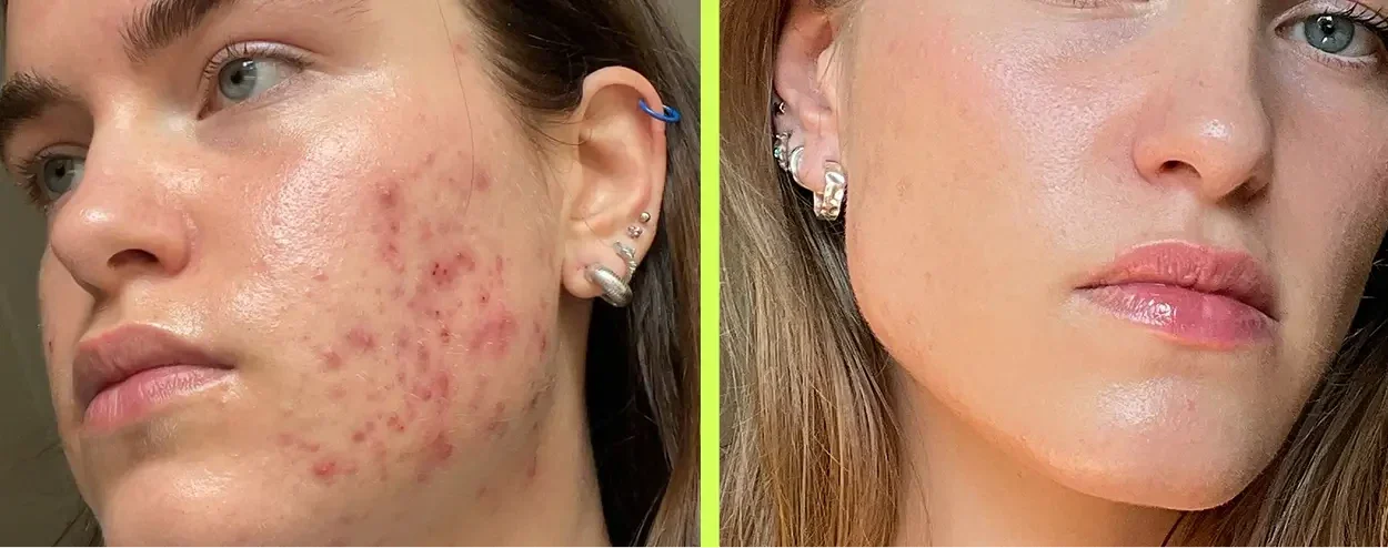 Hormonelle Akne am Kinn und an der Kieferpartie vorher, und eine ruhige, ebenmäßige Haut nach dem Ansatz von innen heraus