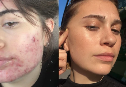 Before / After