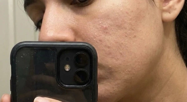 Rough texture or uneven skin